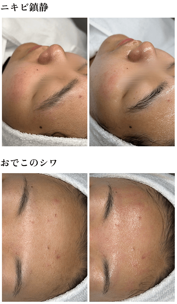 フェイシャル施術前後のおでこの肌状態を比較した写真